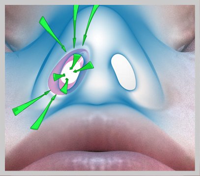 NozNoz Wearable Device in the nose- How to verify the right size